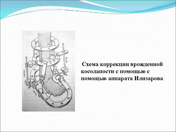 Схема коррекции врожденной косолапости с помощью аппарата Илизарова 