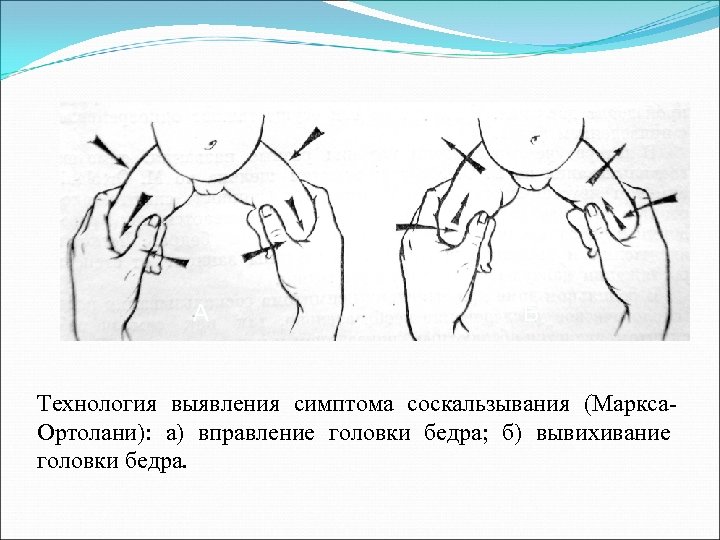 А Б Технология выявления симптома соскальзывания (Маркса. Ортолани): а) вправление головки бедра; б) вывихивание