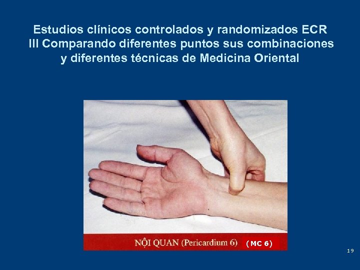 Estudios clínicos controlados y randomizados ECR III Comparando diferentes puntos sus combinaciones y diferentes