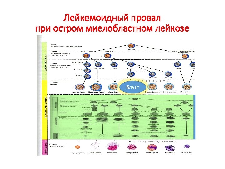 Лейкемоидный провал при остром миелобластном лейкозе бласт 