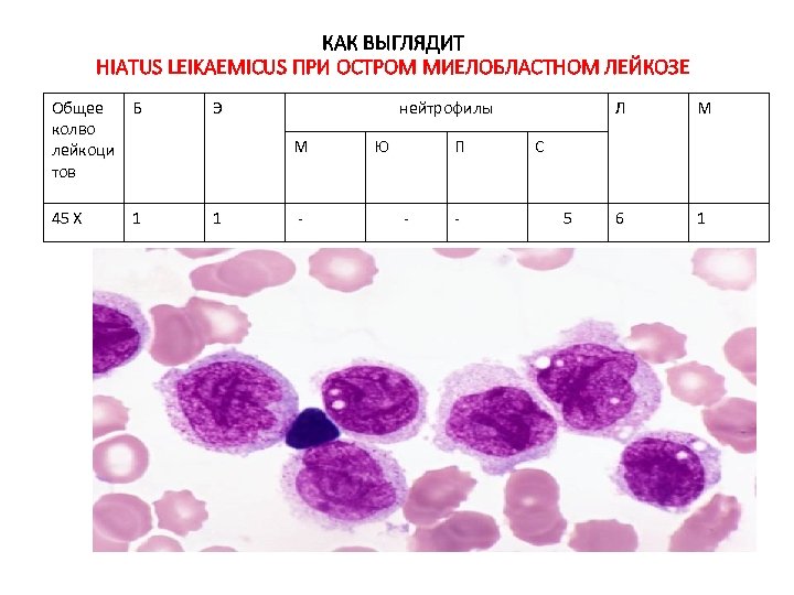 КАК ВЫГЛЯДИТ HIATUS LEIKAEMICUS ПРИ ОСТРОМ МИЕЛОБЛАСТНОМ ЛЕЙКОЗЕ Общее Б колво лейкоци тов Э