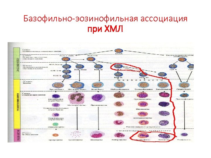 Базофильно-эозинофильная ассоциация при ХМЛ 