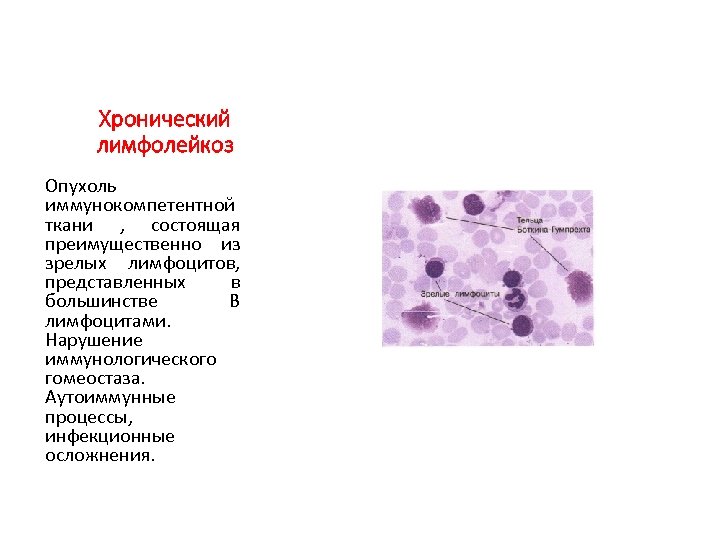 Хронический лимфолейкоз Опухоль иммунокомпетентной ткани , состоящая преимущественно из зрелых лимфоцитов, представленных в большинстве