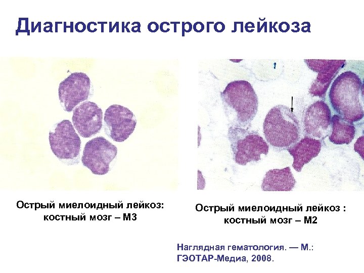 Диагностика лейкоза