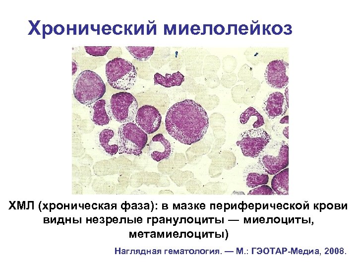 Хр миелолейкоз картина крови