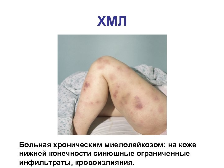 ХМЛ Больная хроническим миелолейкозом: на коже нижней конечности синюшные ограниченные инфильтраты, кровоизлияния. 