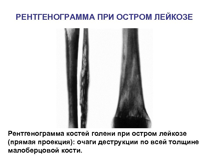 РЕНТГЕНОГРАММА ПРИ ОСТРОМ ЛЕЙКОЗЕ Рентгенограмма костей голени при остром лейкозе (прямая проекция): очаги деструкции