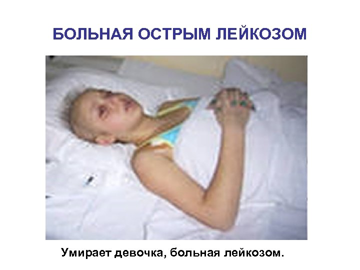 БОЛЬНАЯ ОСТРЫМ ЛЕЙКОЗОМ Умирает девочка, больная лейкозом. 