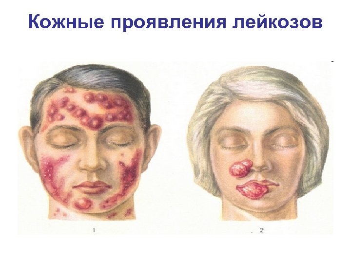 Кожные проявления лейкозов 