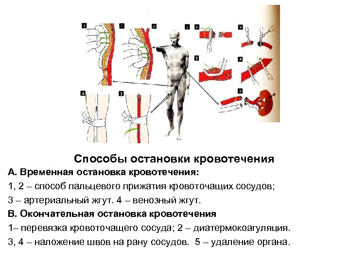 Способы остановки кровотечений тест