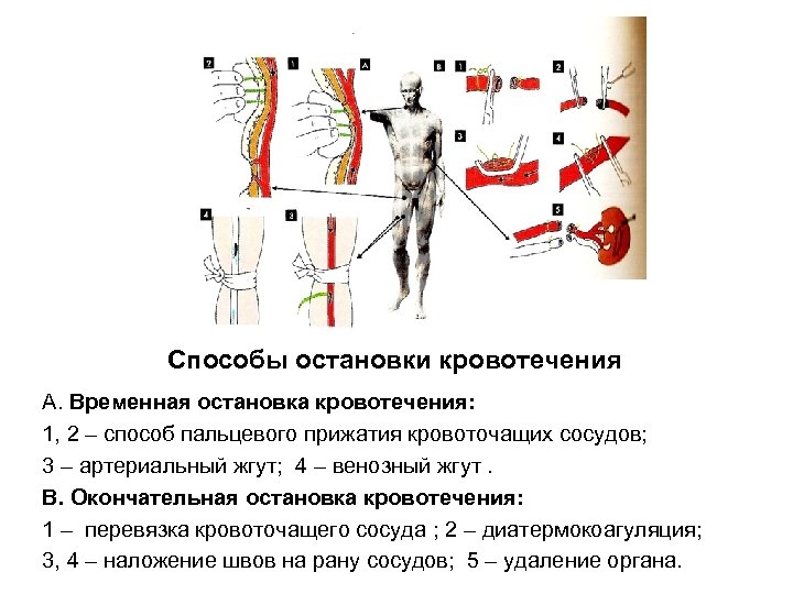 Как остановить кровотечение дюфастоном схема