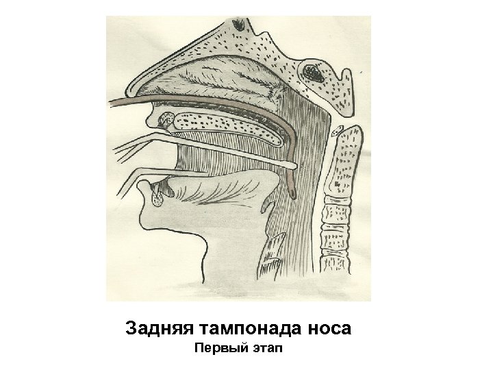 Тампонада. Передняя и задняя тампонада носа алгоритм. Задняя тампонада носа методика. Остановка носового кровотечения передняя задняя тампонада. Петлевая тампонада носа.