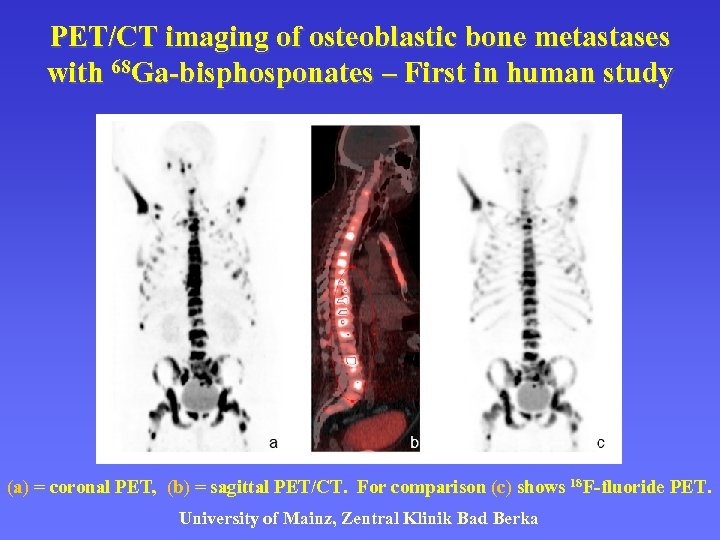 PET/CT imaging of osteoblastic bone metastases with 68 Ga-bisphosponates – First in human study