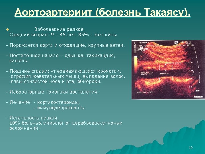 Аортоартериит (болезнь Такаясу). Заболевание редкое. Средний возраст 9 – 45 лет. 85% женщины. u