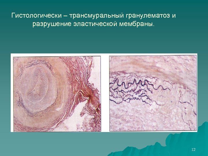 Гистологически – трансмуральный гранулематоз и разрушение эластической мембраны. 12 