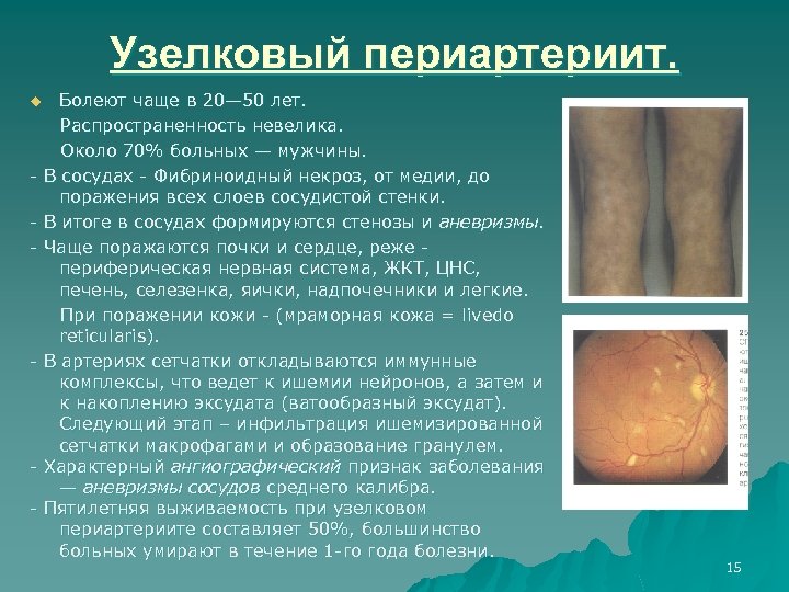 Узелковый периартериит. u Болеют чаще в 20— 50 лет. Распространенность невелика. Около 70% больных