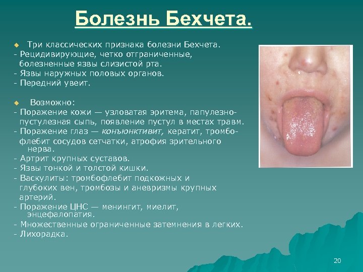 Болезнь Бехчета. Три классических признака болезни Бехчета. Рецидивирующие, четко отграниченные, болезненные язвы слизистой рта.