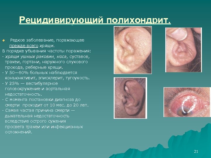 Рецидивирующий полихондрит. Редкое заболевание, поражающее прежде всего хрящи. В порядке убывания частоты поражения: хрящи