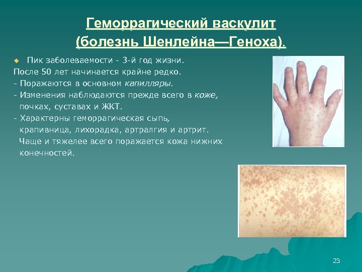 Геморрагический васкулит (болезнь Шенлейна—Геноха). Пик заболеваемости 3 й год жизни. После 50 лет начинается