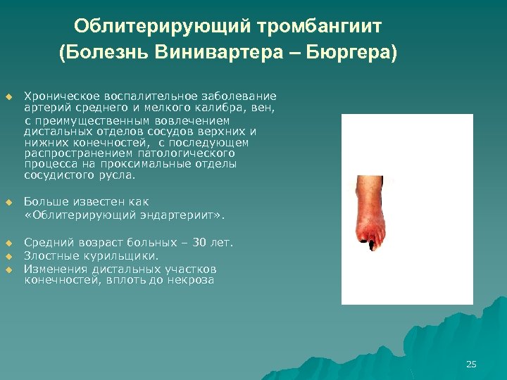 Облитерирующий тромбангиит (Болезнь Винивартера – Бюргера) u Хроническое воспалительное заболевание артерий среднего и мелкого