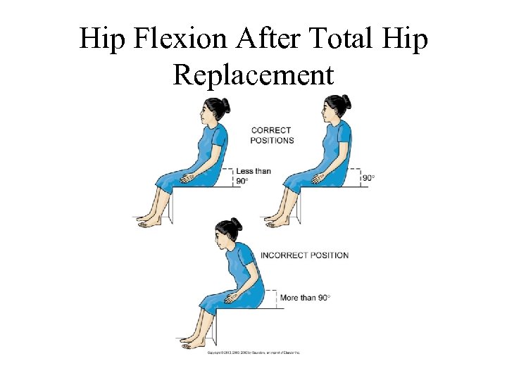 Hip Flexion After Total Hip Replacement 