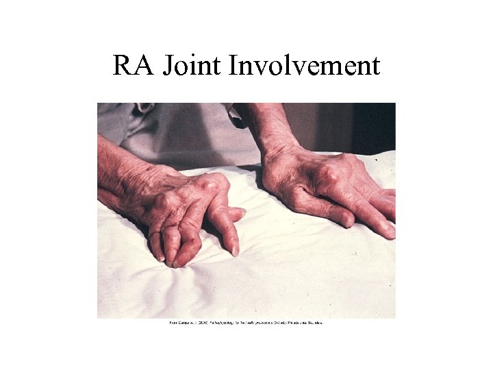 RA Joint Involvement 