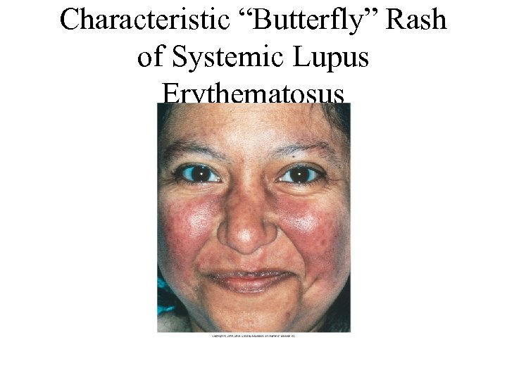 Characteristic “Butterfly” Rash of Systemic Lupus Erythematosus 