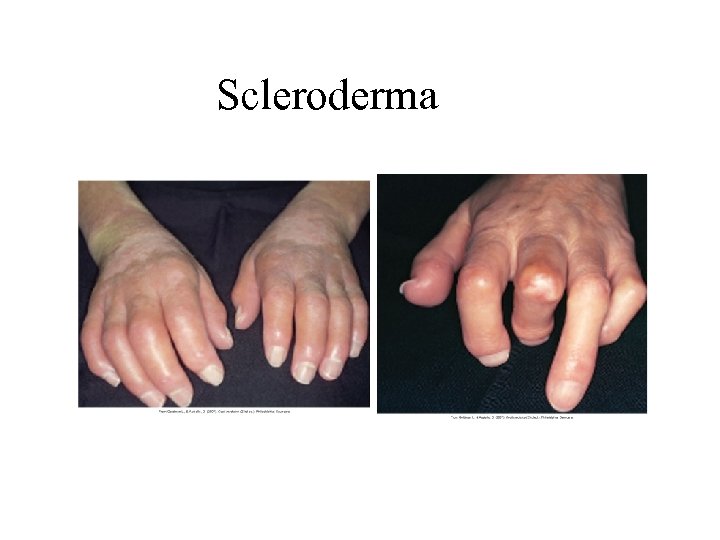 Scleroderma 