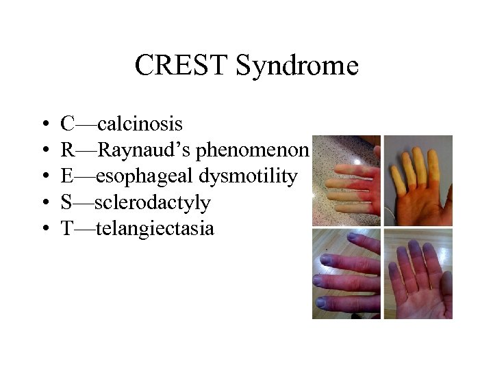 CREST Syndrome • • • C—calcinosis R—Raynaud’s phenomenon E—esophageal dysmotility S—sclerodactyly T—telangiectasia 