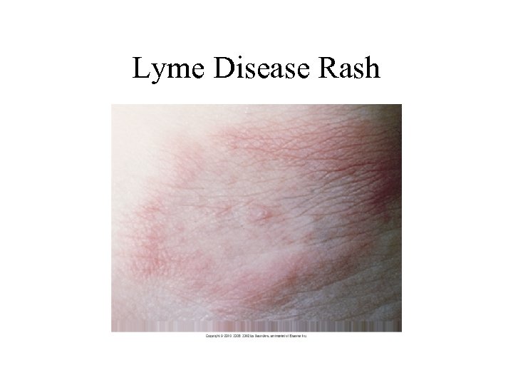 Lyme Disease Rash 