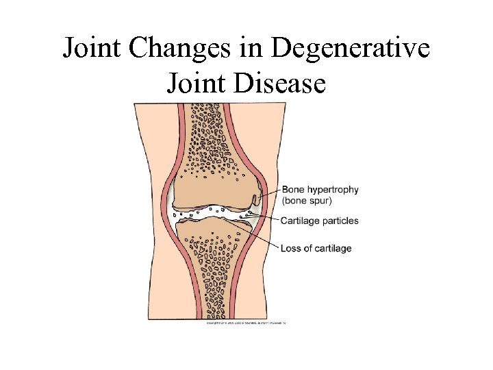 Joint Changes in Degenerative Joint Disease 