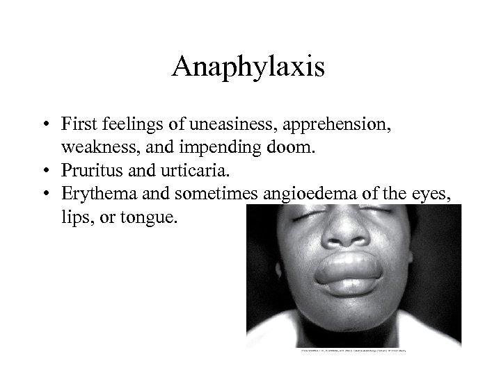 Anaphylaxis • First feelings of uneasiness, apprehension, weakness, and impending doom. • Pruritus and