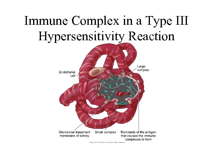 Immune Complex in a Type III Hypersensitivity Reaction 