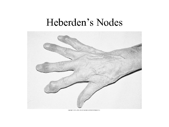 Heberden’s Nodes 