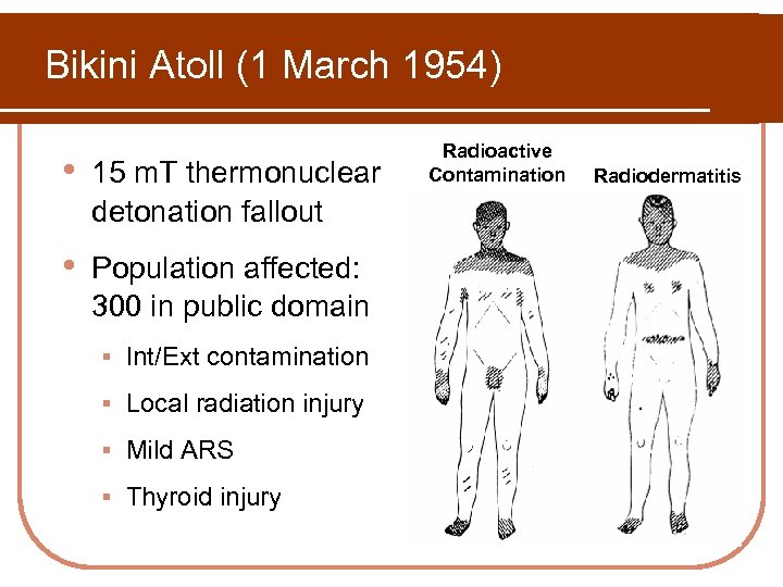 Bikini Atoll (1 March 1954) • 15 m. T thermonuclear detonation fallout • Population