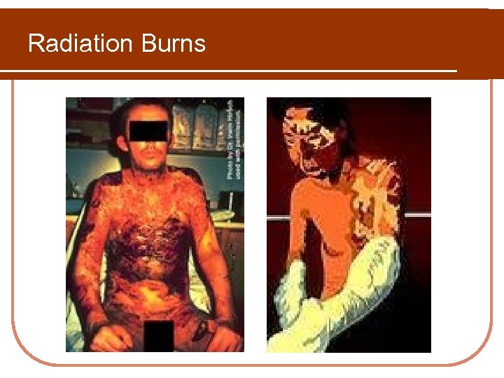 Radiation Burns 