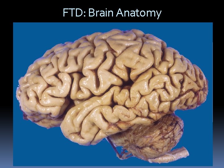 FTD: Brain Anatomy 