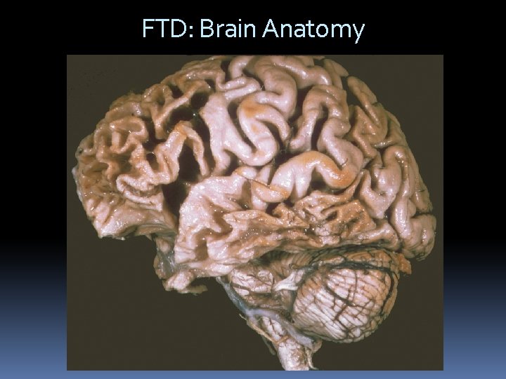 FTD: Brain Anatomy 