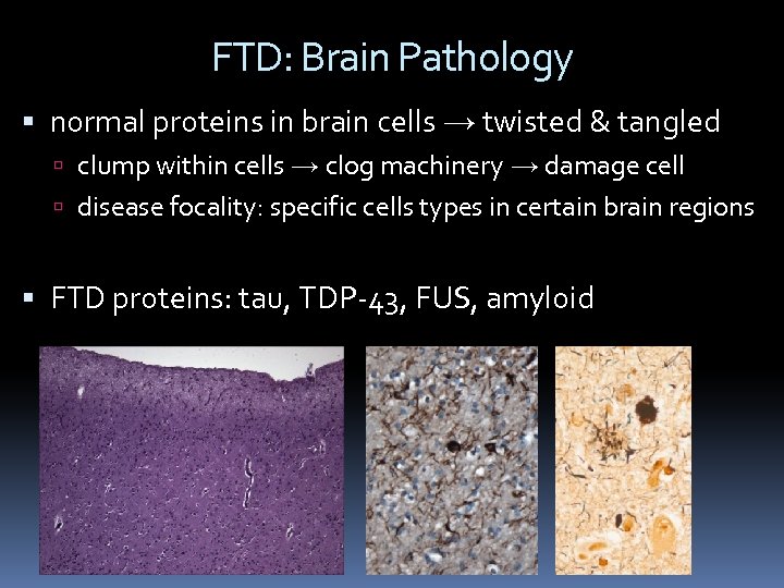 FTD: Brain Pathology normal proteins in brain cells → twisted & tangled clump within