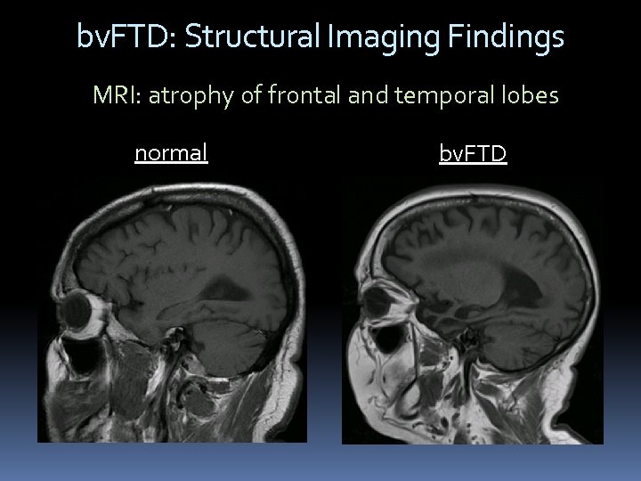 bv. FTD: Structural Imaging Findings MRI: atrophy of frontal and temporal lobes normal bv.