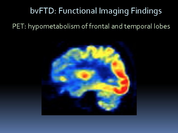 bv. FTD: Functional Imaging Findings PET: hypometabolism of frontal and temporal lobes 