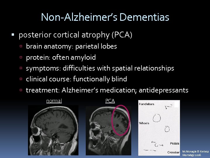 Non-Alzheimer’s Dementias posterior cortical atrophy (PCA) brain anatomy: parietal lobes protein: often amyloid symptoms: