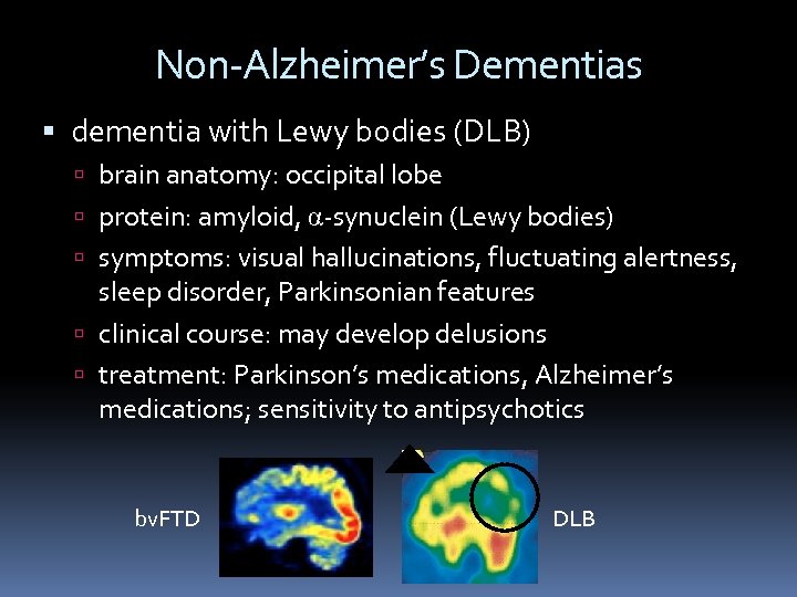 Non-Alzheimer’s Dementias dementia with Lewy bodies (DLB) brain anatomy: occipital lobe protein: amyloid, α-synuclein