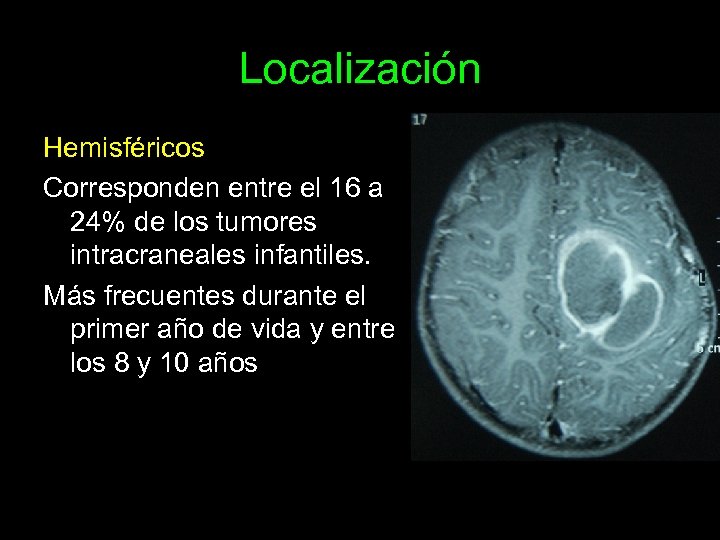 Localización Hemisféricos Corresponden entre el 16 a 24% de los tumores intracraneales infantiles. Más