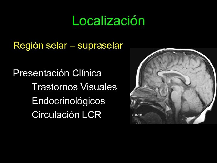 Localización Región selar – supraselar Presentación Clínica Trastornos Visuales Endocrinológicos Circulación LCR 