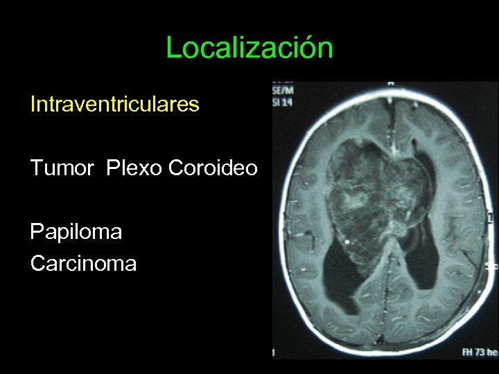 Localización Intraventriculares Tumor Plexo Coroideo Papiloma Carcinoma 