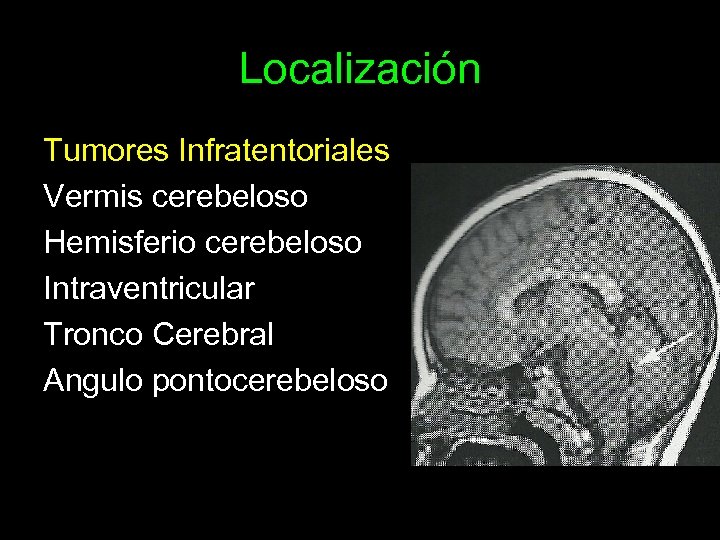 Localización Tumores Infratentoriales Vermis cerebeloso Hemisferio cerebeloso Intraventricular Tronco Cerebral Angulo pontocerebeloso 