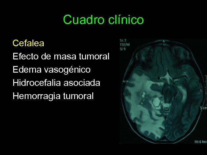 Cuadro clínico Cefalea Efecto de masa tumoral Edema vasogénico Hidrocefalia asociada Hemorragia tumoral 