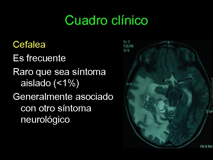 Cuadro clínico Cefalea Es frecuente Raro que sea síntoma aislado (<1%) Generalmente asociado con