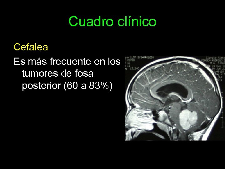 Cuadro clínico Cefalea Es más frecuente en los tumores de fosa posterior (60 a